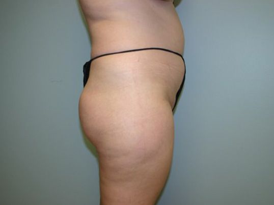 Brazilian Butt Lift Before & After