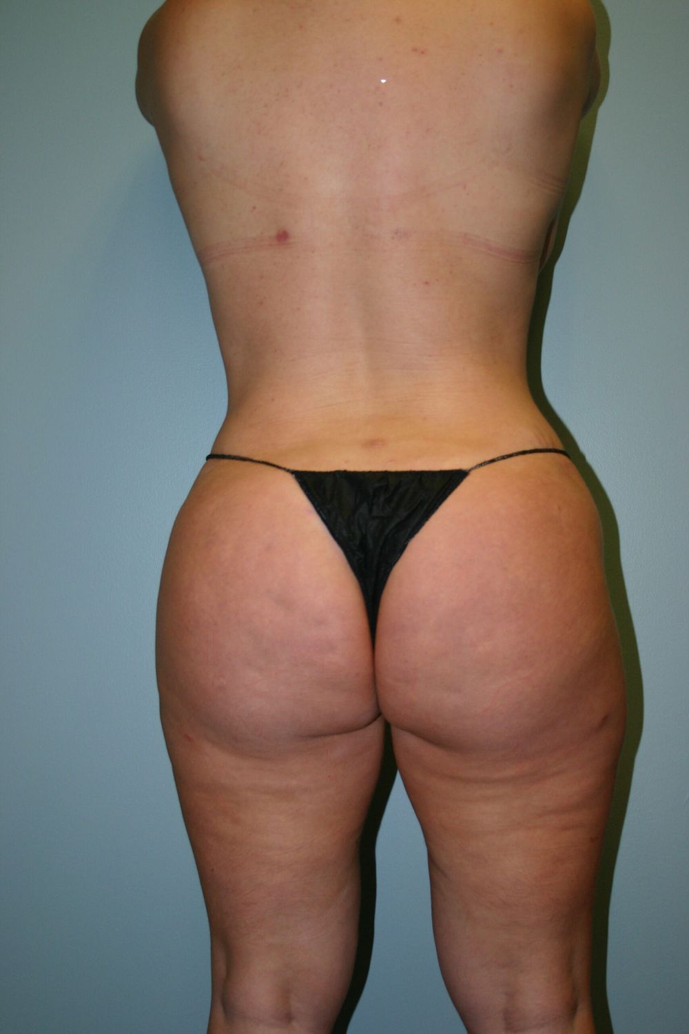 Brazilian Butt Lift Before & After