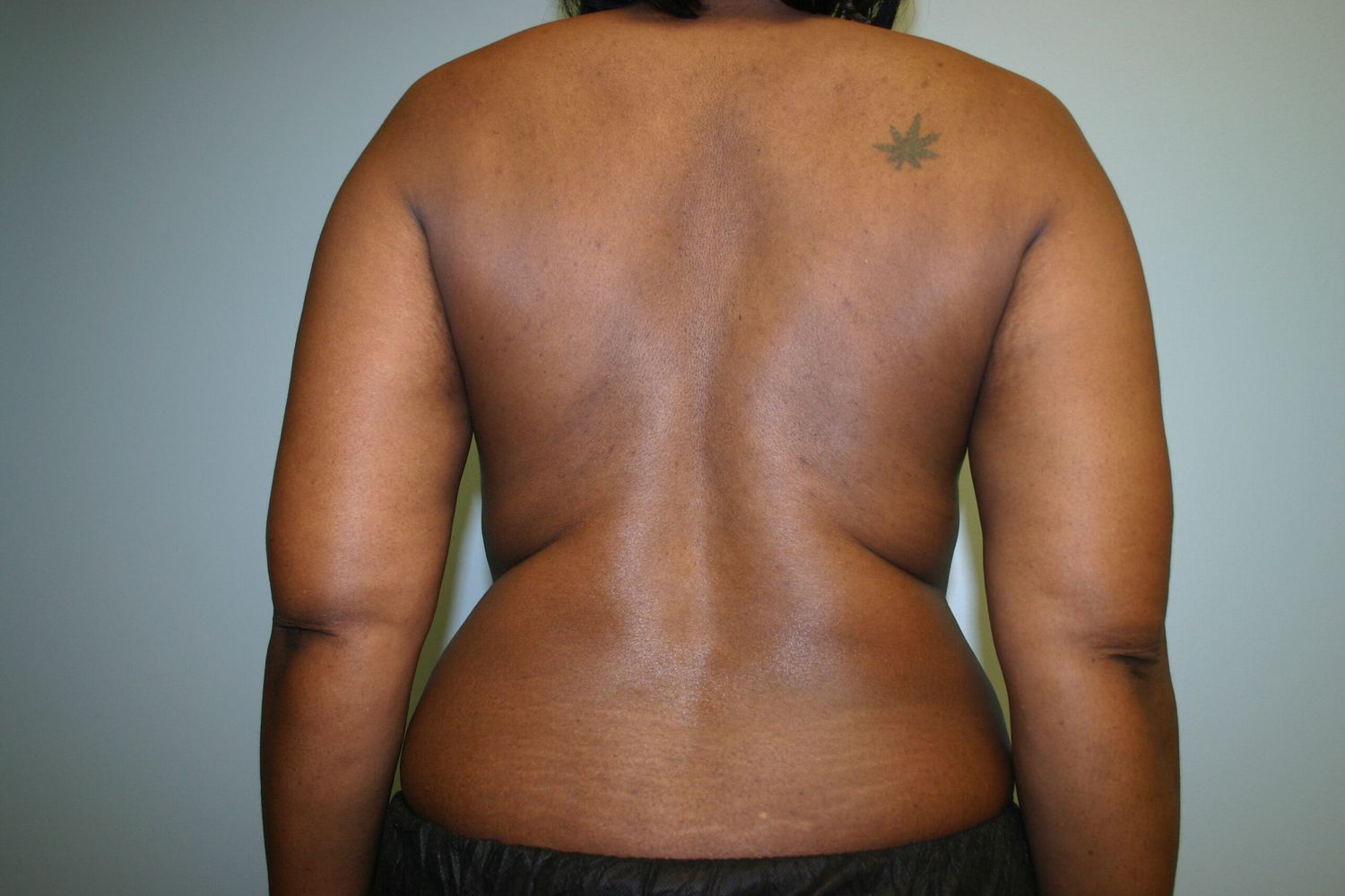 Brazilian Butt Lift Before & After