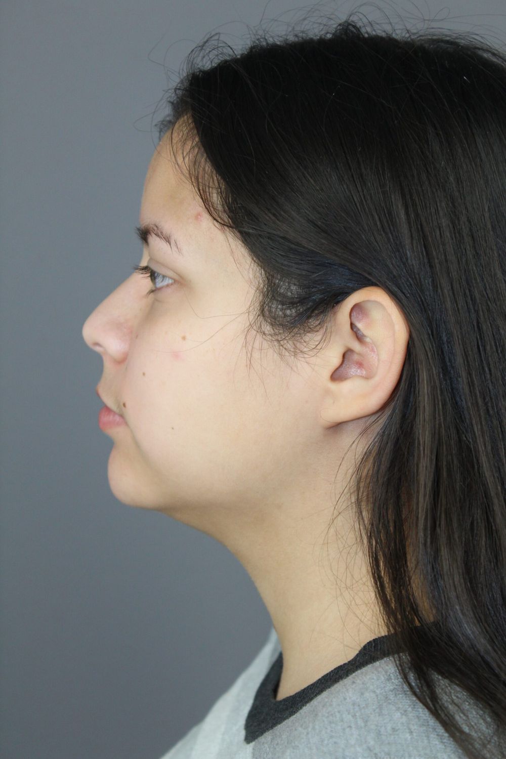 Liposuction Before & After