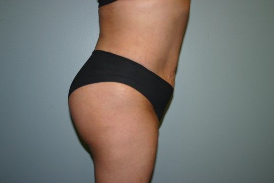 Liposuction Before & After