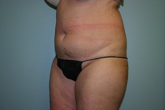 Liposuction Before & After