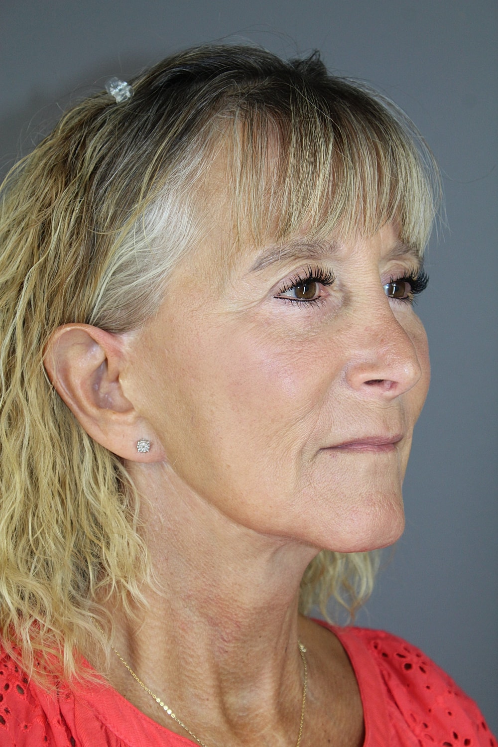 Eyelid Surgery Before & After