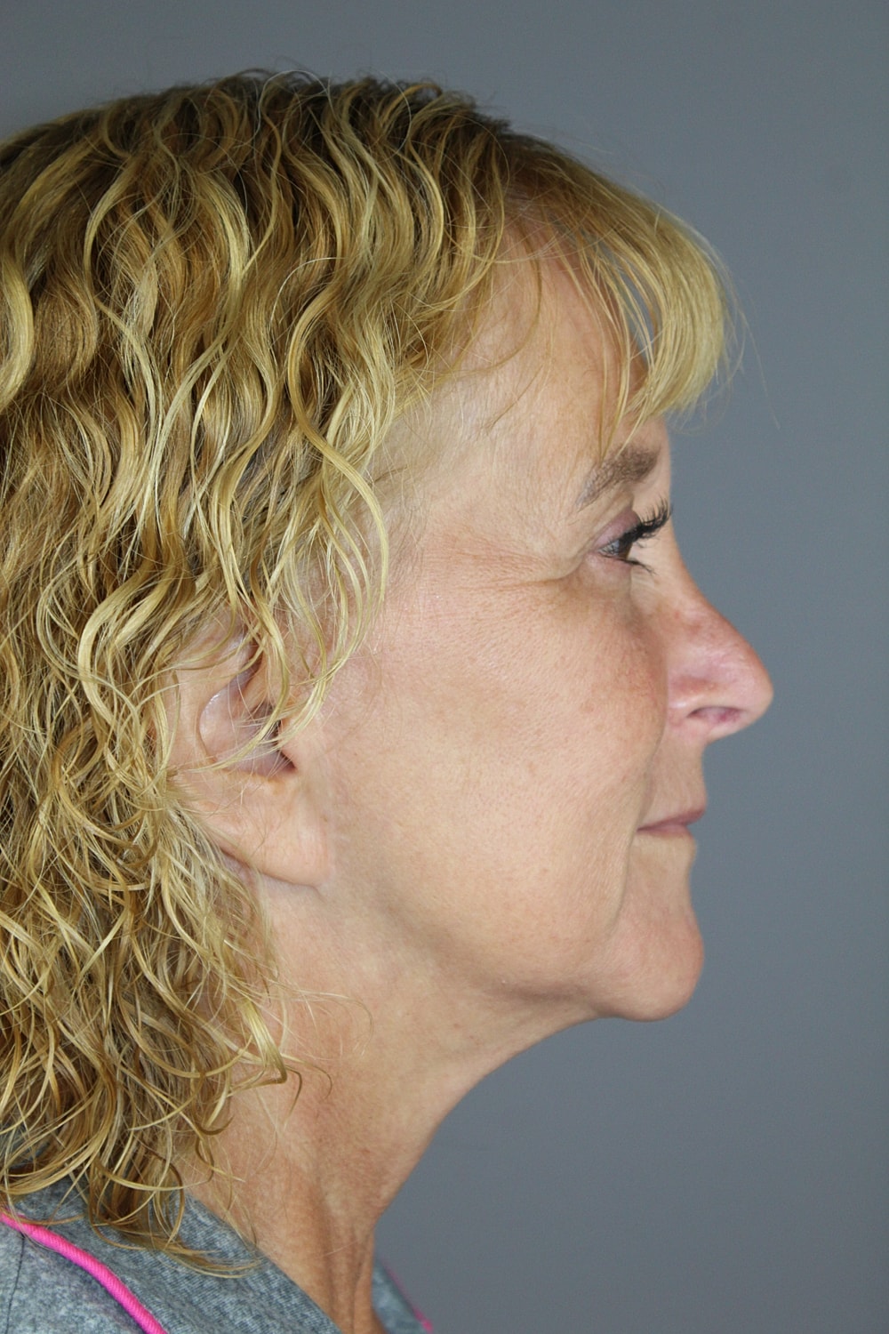Eyelid Surgery Before & After