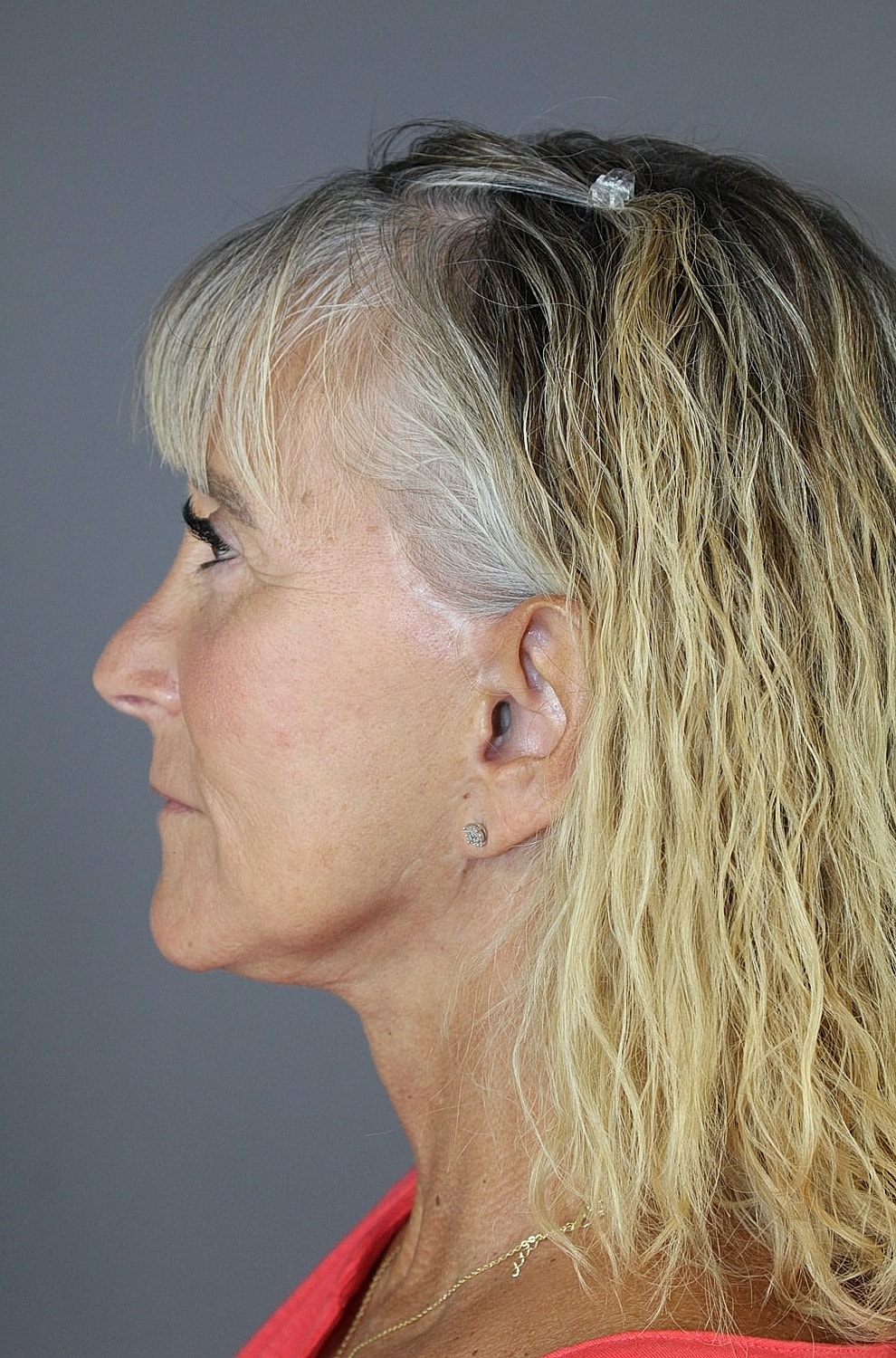 Eyelid Surgery Before & After