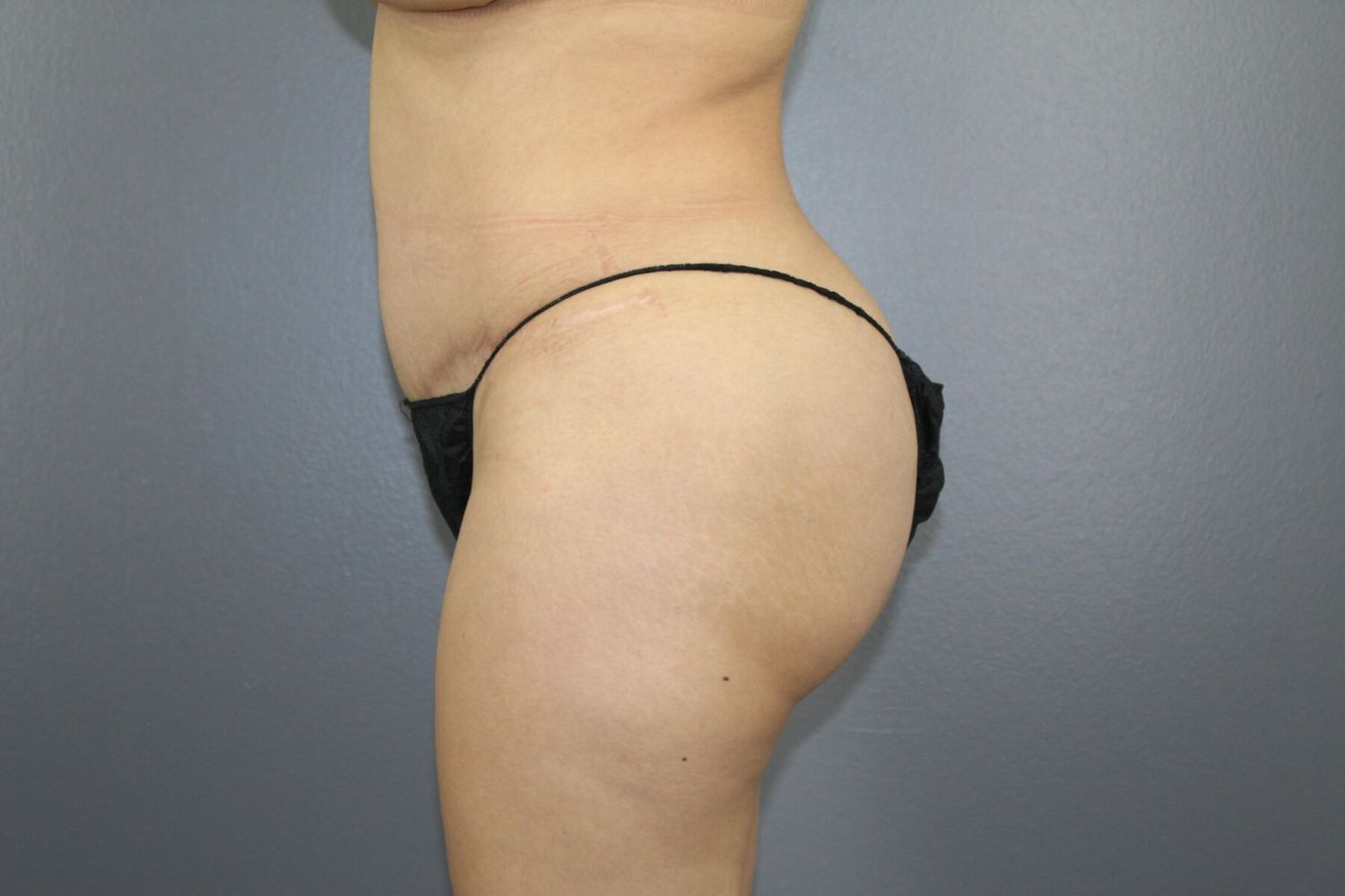 Fat Transfer Before & After