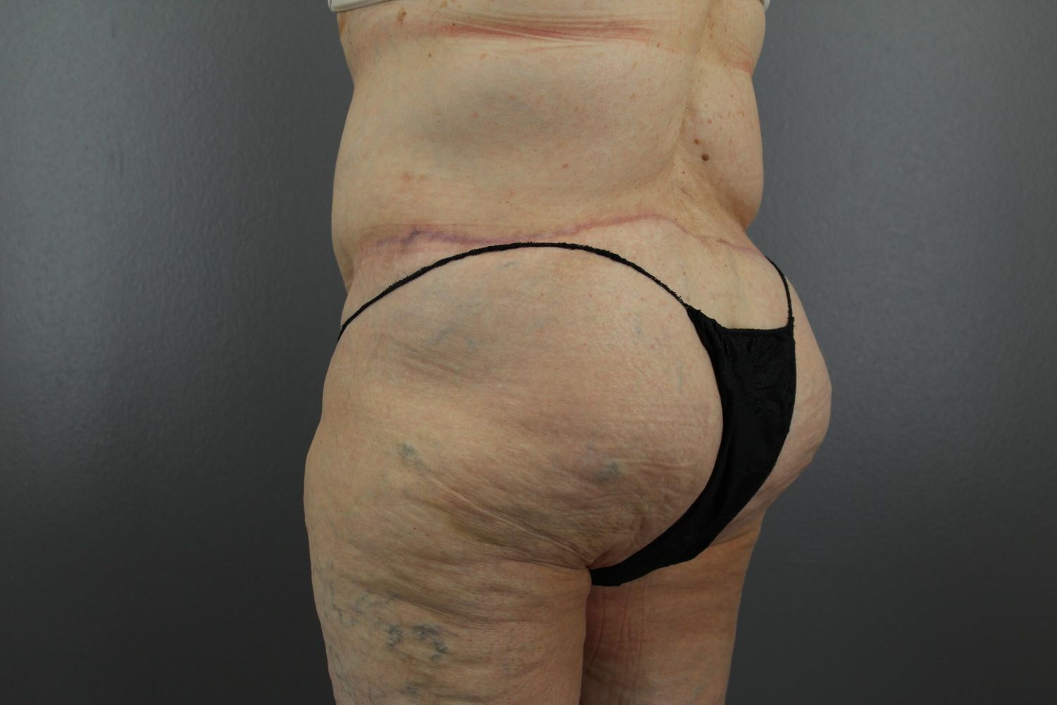 Lower Body Lift Before & After