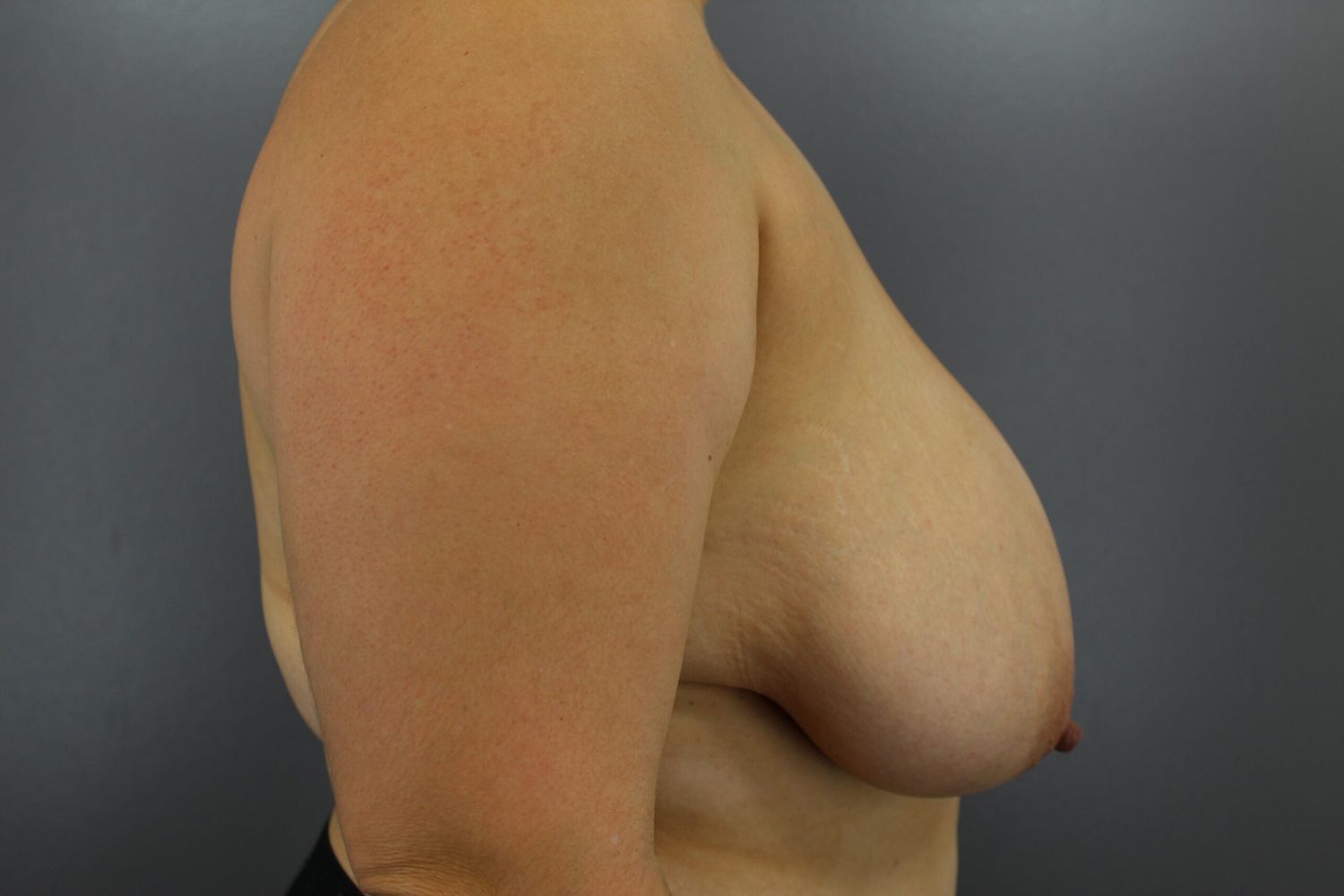 Breast Lift Before & After