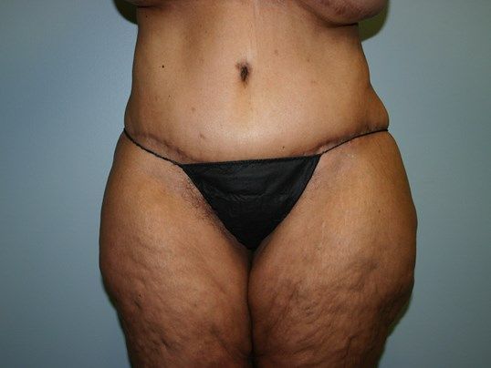 Surgery After Weight Loss Before & After