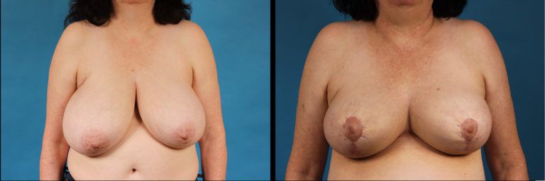 Dr. Kath breast reduction