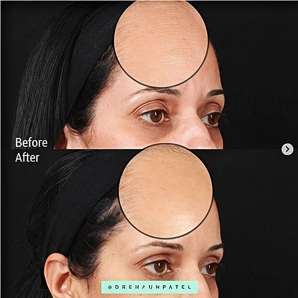 botox skin quality