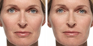 radiesse before after2 0 1