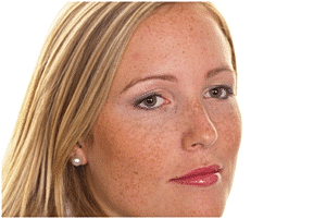 skin hyperpigmentation 300x201 1