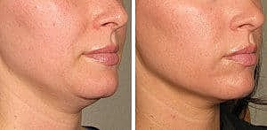 ultherapy 0132p h before 120daysafter lower low res e1426567985540 300x147 300x147 1