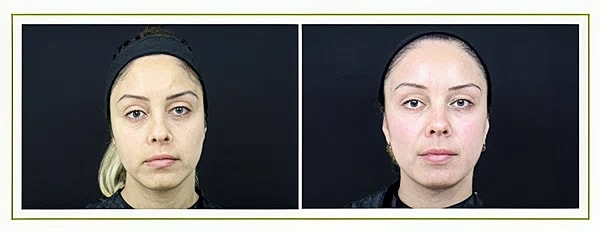 under eye filler before after