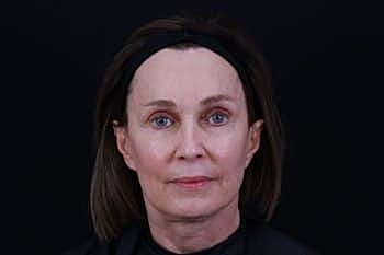 Dermal Fillers Before & After