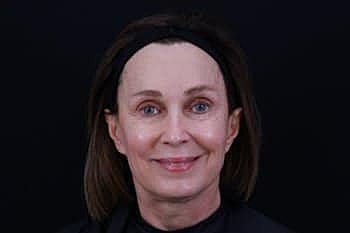 Dermal Fillers Before & After