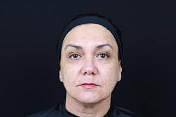 Dermal Fillers Before & After