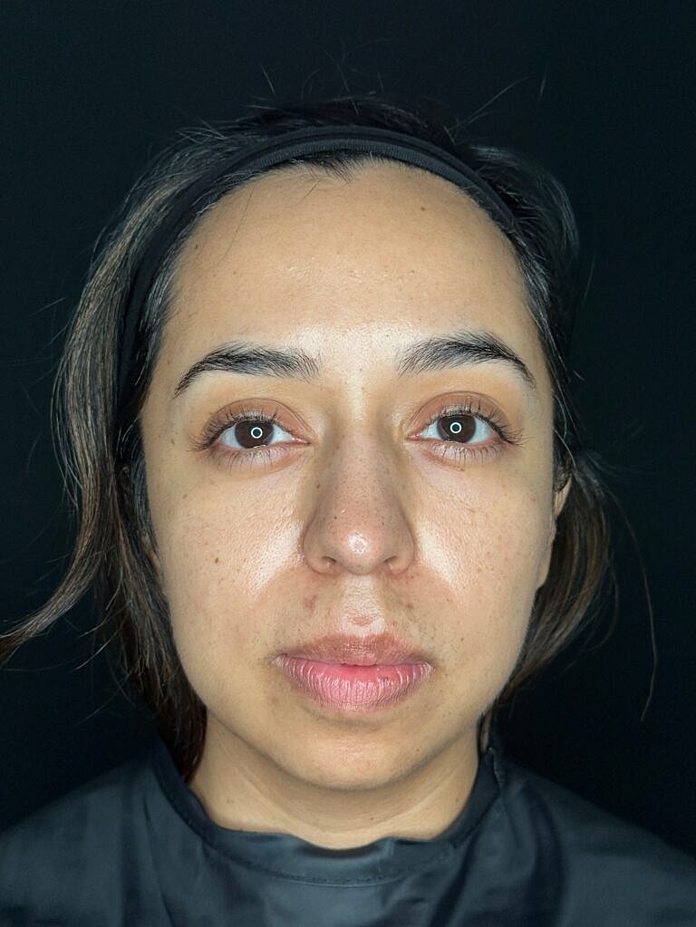 Dermal Fillers Before & After