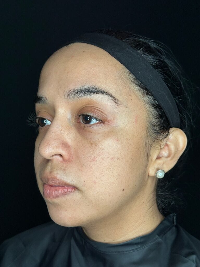 Dermal Fillers Before & After