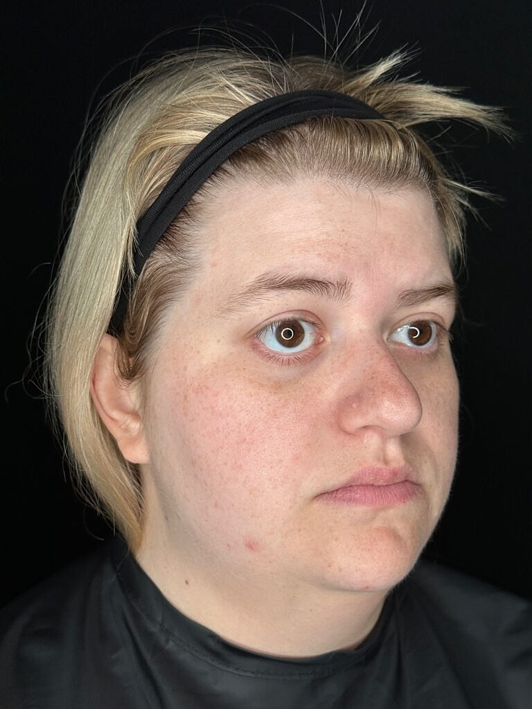 Dermal Fillers Before & After