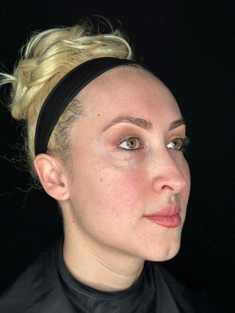 Dermal Fillers Before & After