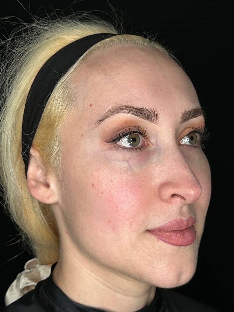 Dermal Fillers Before & After