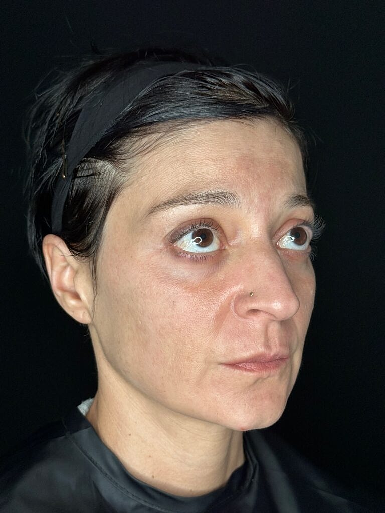 Dermal Fillers Before & After