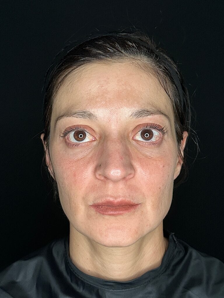 Dermal Fillers Before & After