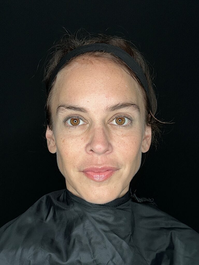 Dermal Fillers Before & After