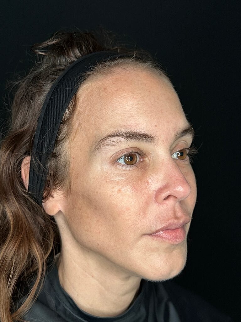 Dermal Fillers Before & After