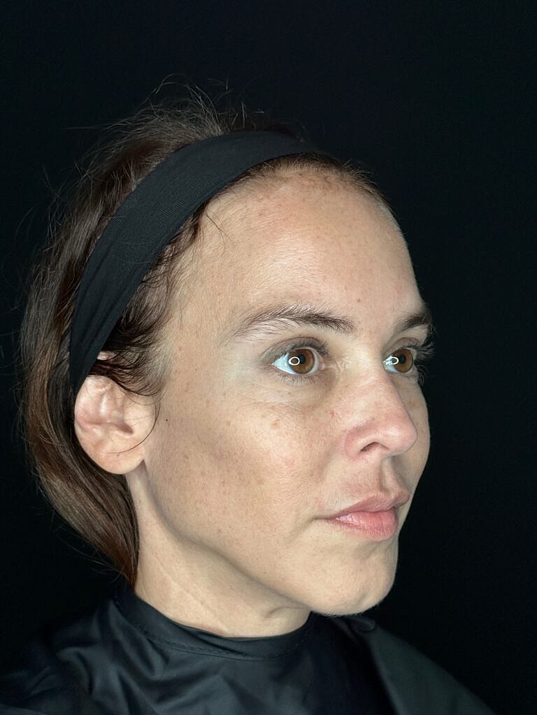 Dermal Fillers Before & After