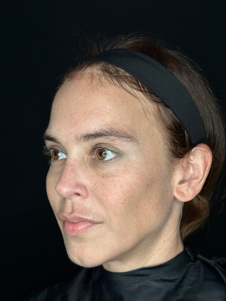 Dermal Fillers Before & After