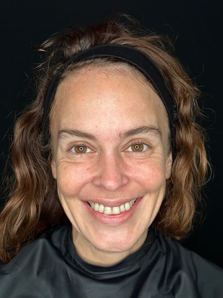 Dermal Fillers Before & After