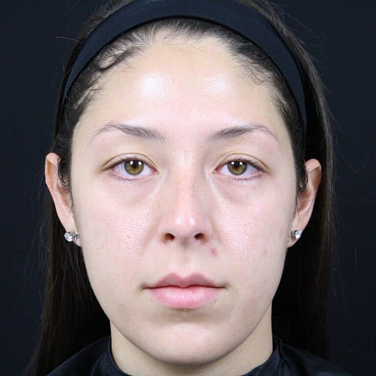 Dermal Fillers Before & After