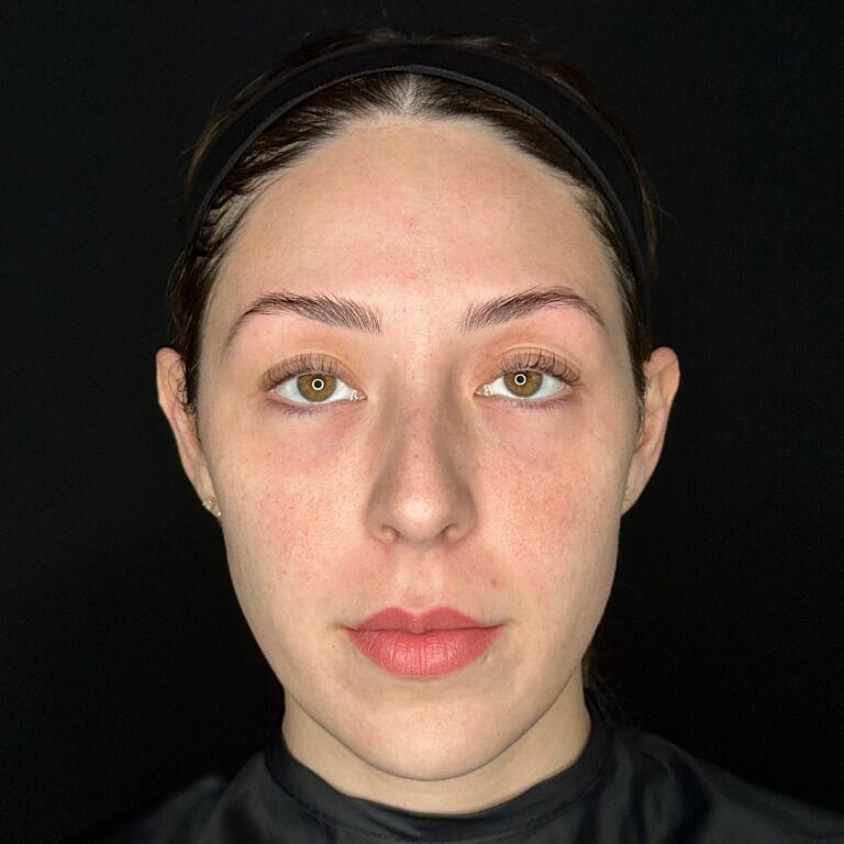 Dermal Fillers Before & After