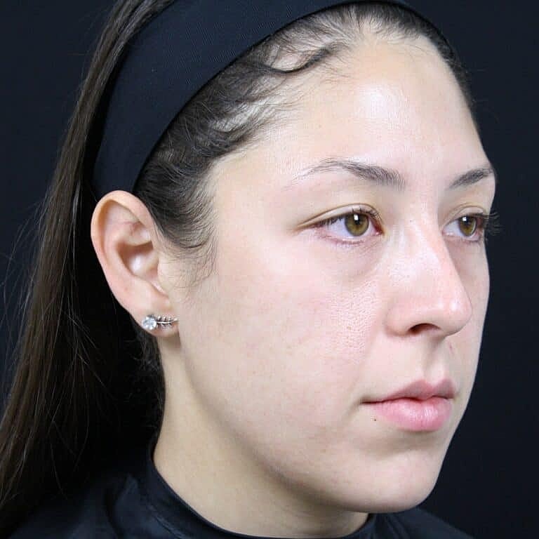 Dermal Fillers Before & After