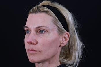 Dermal Fillers Before & After
