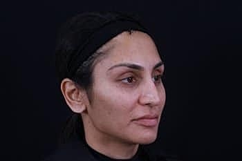 Dermal Fillers Before & After