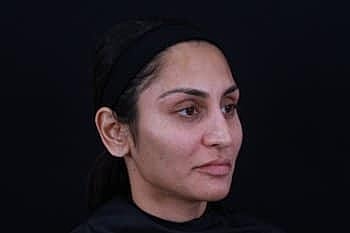 Dermal Fillers Before & After