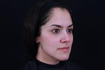Dermal Fillers Before & After