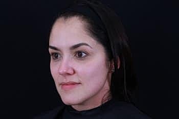 Dermal Fillers Before & After