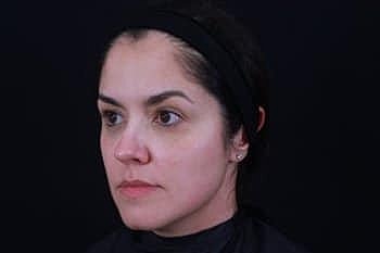Dermal Fillers Before & After