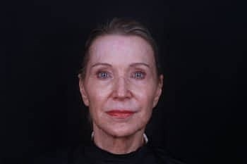 Dermal Fillers Before & After