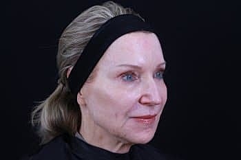 Dermal Fillers Before & After