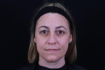 Dermal Fillers Before & After