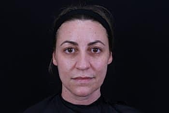 Dermal Fillers Before & After