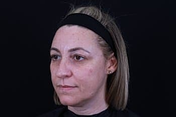 Dermal Fillers Before & After