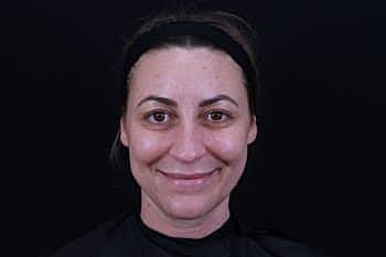 Dermal Fillers Before & After