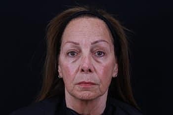 Dermal Fillers Before & After